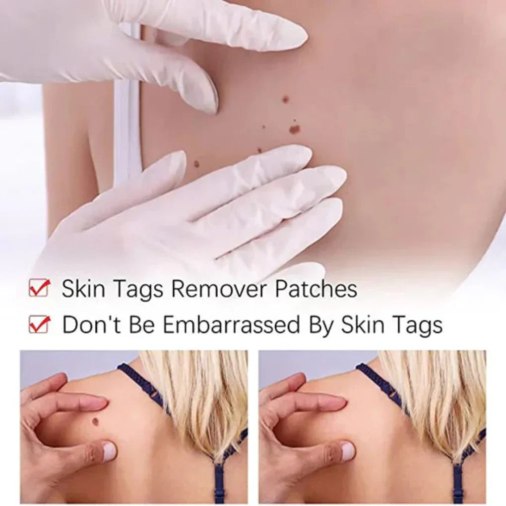 Charly | Natural Skin Tag & Mole Remover Pen