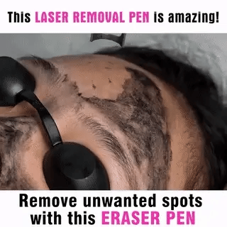 AstraGlow Home Laser Pen For Tattoo, Mole And Freckle Removal