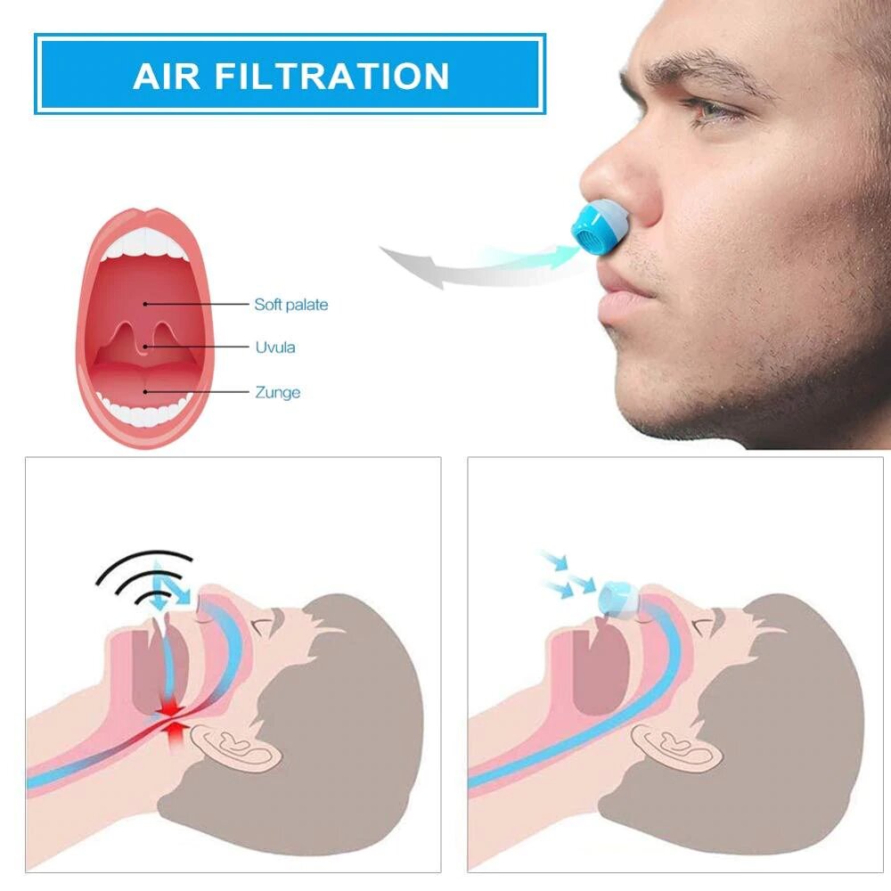 Charly | Anti-Snoring Device | Tubeless, Maskless Micro-CPAP