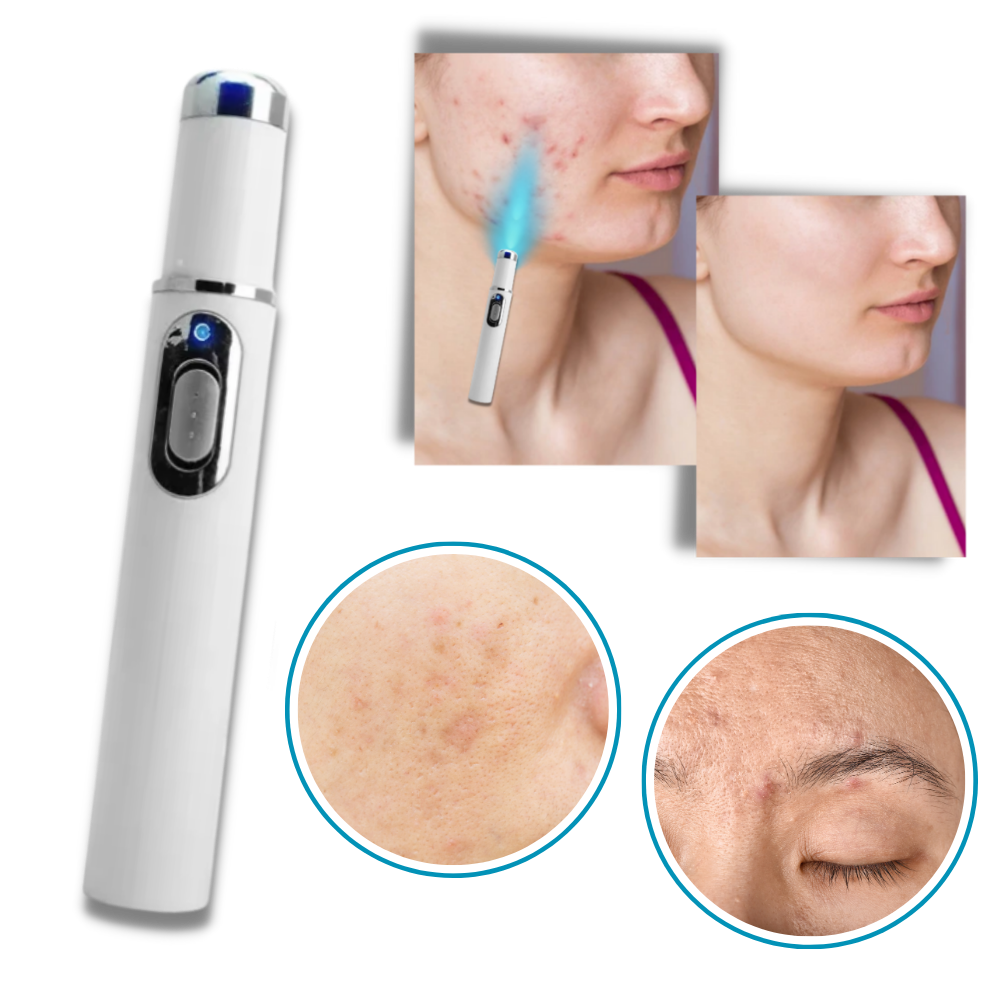 DermaPure | Portable Laser Therapy for a Brighter Complexion